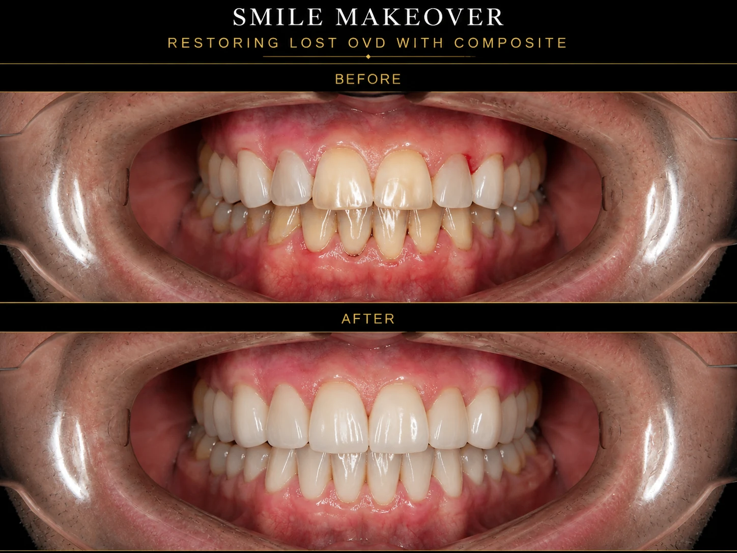Full mouth composite rehabilitation restoring lost OVD before and after treatment by Dr Samira Sharifi in Dubai